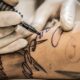Tattoo Removal