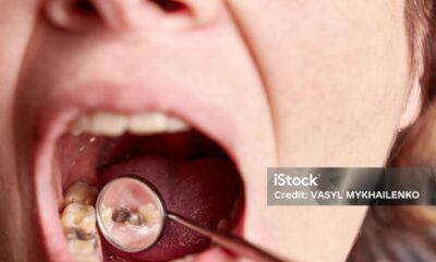 How Long Does It Take to Fill a Cavity