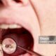 How Long Does It Take to Fill a Cavity