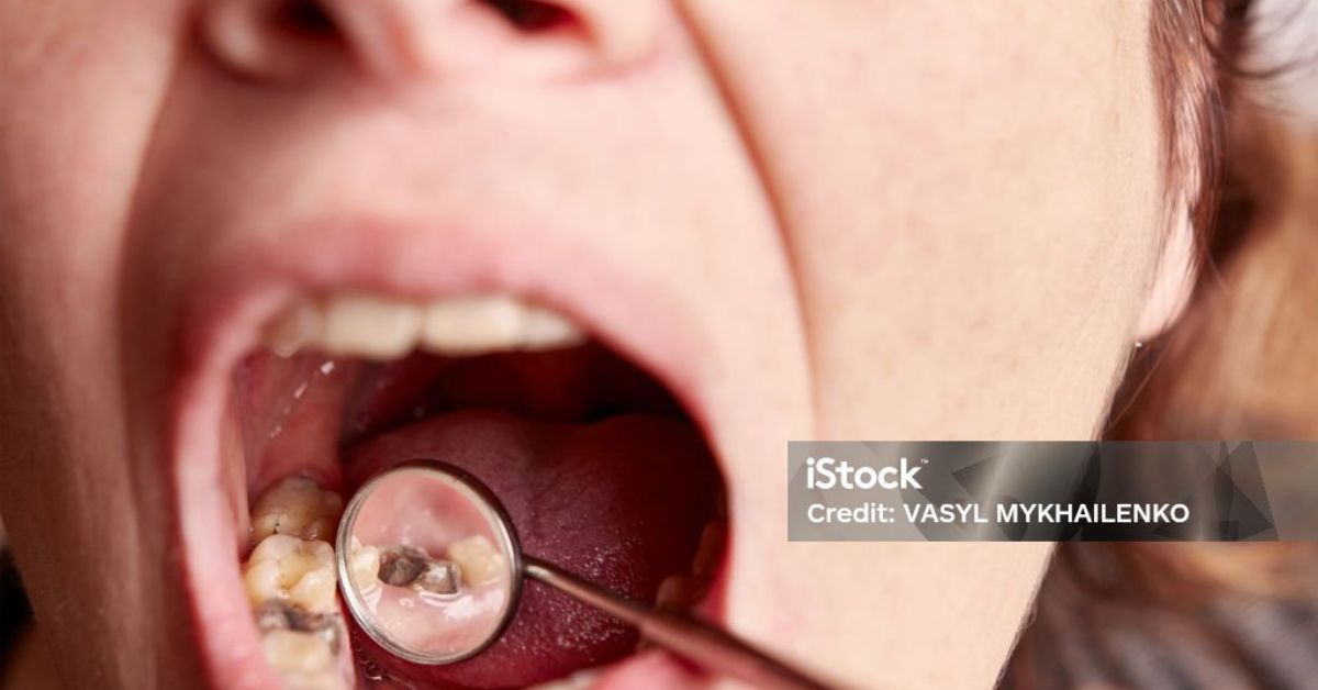 How Long Does It Take to Fill a Cavity